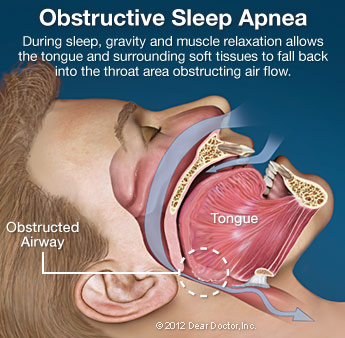 Obstructive Sleep Apnea.